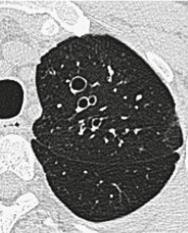 Hochhegger B. Computed tomography in the diagnosis of bronchiectasis. Eur Respir J. 2015 Aug;46(2):576-7. Hochhegger B.