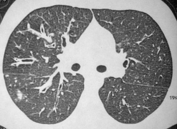 Bronquiectasias