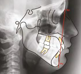 Cefalometria Técnicas de Diagnóstico e Procedimentos 057 09 10 11 12 13 14 Fig.09 Plano ramo mandibular Ar-Goc (Análise de Jarabak). Fig.10 Plano Ba-Na (Análise de Ricketts).