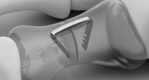 NiTi permite que os grampos sejam usados como pinças que comprimem as partes fraturadas, estabilizando e fixando a fratura até sua consolidação: Figura 2 Aplicação do Grampo Ósseo Superelástico Com