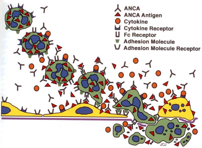 Glomerulonefrite crescêntica 50% dos glomérulos Tipo I linear - ac anti MBG