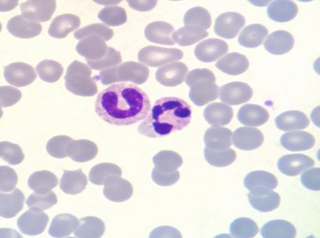 A) Imunoensaio Cromatográfico B) Colorimétrico C) Cinético D) Enzimático 8) O quadro clinico da Dengue, vem acompanhado de sinais e sintomas diversos, contudo, o laboratório de análises clínicas tem