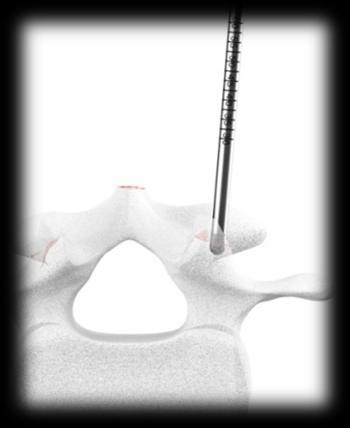 Fig. 5 Com pressão controlada em uma série de curtos movimentos rotatórios e firmes, o Prob/Medidor de Profundidade é inserido até o pedículo (Fig. 6).