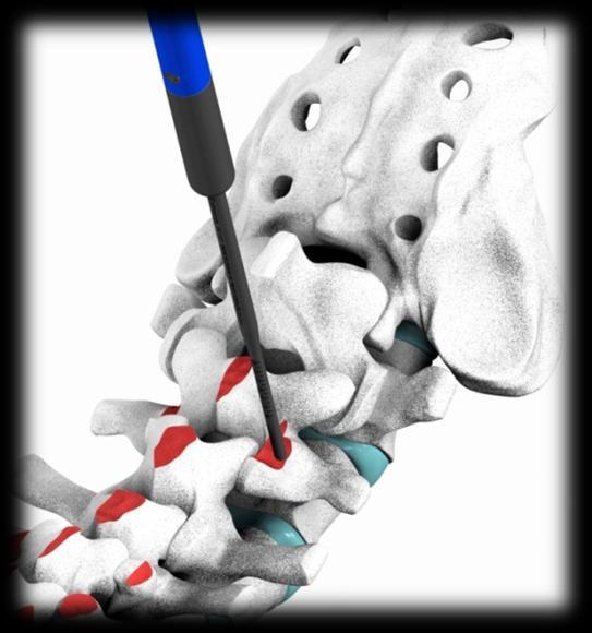 do pedículo será compactado. O osso osteoporótico da cortical do pedículo apresenta risco aumentado de ruptura pelo Prob/Medidor de Profundidade em todos os planos.
