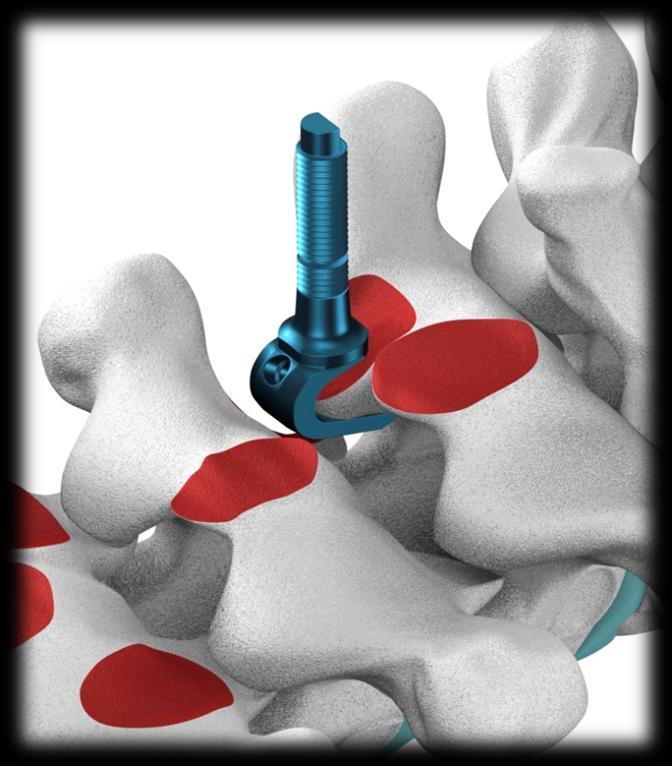 Fig. 18 O Gancho Pedicular Pequeno é fixado