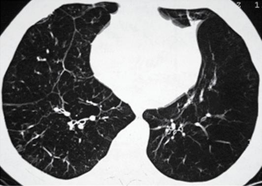 Em um estudo sobre características de asma em pacientes do registro norte-americano de AAT, 50% apresentavam reversibilidade da obstrução ao fluxo aéreo na prova de função pulmonar, e 22% preencheram