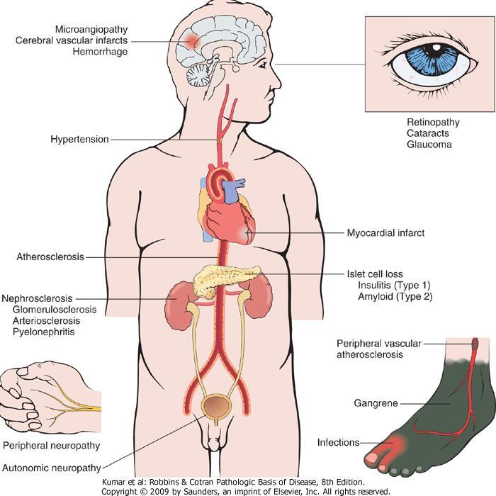 Diabetes Mellitus Hiperglicemia Nefropatia Retinopatia Neuropatia