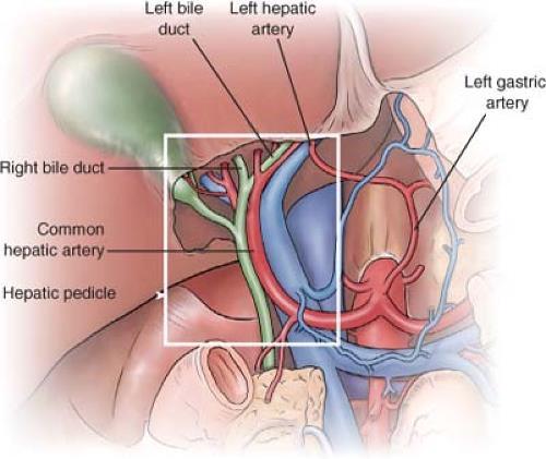 ANATOMIA DAS VIAS BILIARES Ducto hepático esquerdo drena segmentos II, III e IV Ducto hepático