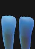 resinas concorrentes, efetuadas sobre dentes acrílicos VITA em cor A2 (parâmetro de avaliação ótica) Restauração classe IV com Brilliant NG CONCEITO DUO SHADE: Rearranjando-se as paletas de cor na