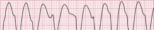 cardíaco Traçado ECG Fonte: ECGpedia.org.