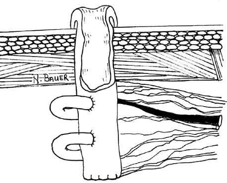 A cirurgia de Bricker consiste na implantação término-lateral dos ureteres em um segmento de íleo de aproximadamente 15 cm a 20 cm, selecionado de 10 cm a 15 cm da válvula ileocecal.