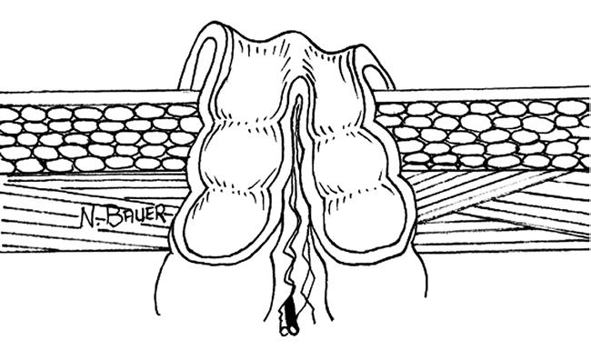 Na ileostomia ou colostomia em alça, a parede anterior da alça intestinal é aberta com um pequeno corte, a fim de eliminar o conteúdo fecal, mas a alça mantém-se unida na parte posterior (FIG. 15).