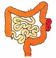 abdominal, evertidas e suturadas na derme ou no tecido subcutâneo. As bocas podem ser exteriorizadas no mesmo sítio do abdome, de forma justaposta (FIG.