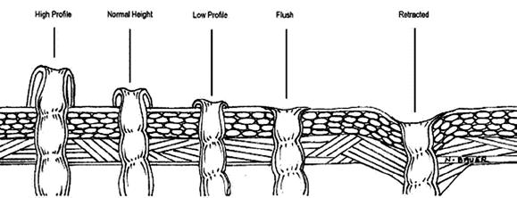25), o estoma pode ser classificado em perfil alto (acima de 2,5 cm), altura normal (entre 1,5 cm e 2,5 cm), perfil baixo (até 1,5 cm), altura da pele (sem protrusão), retraído (abaixo do nível da