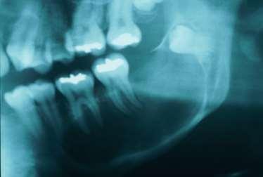 Introdução provocar edema, atraso na erupção dentária, mobilidade e sensibilidade nos dentes e ocasionalmente supuração quística (11,12,16).