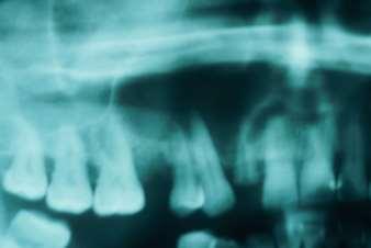 Introdução Figura 4: Aspeto radiográfico de QO Radicular. O Quisto Odontogénico Paradentário (QO Paradentário) deriva do ligamento periodontal.