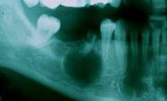 Resultados Nenhum QO Radicular possuía dentes inclusos associados à lesão, tal como nenhum caso regista síndromes associados. Imagiologicamente todas as lesões eram uniloculares (100,0%, n=222).