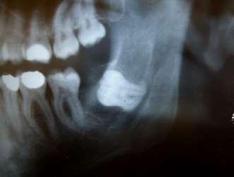 Resultados Figura 11: Aspeto imagiológico de QO Dentígero. Registaram-se 3 QO Dentígeros que recidivaram (3,9%), o mesmo número de casos foi obtido para novos primários (3,9%, n=3).