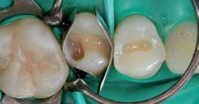 marginal distal do dente 15 reconstruída