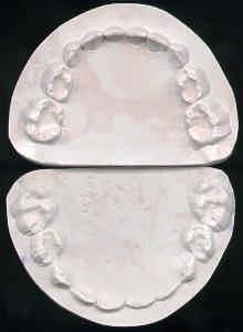 Material e Método 71 solicitando a criança mordê-lo até que as cúspides dos dentes superiores e inferiores ficassem registradas na cera.