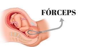 vaginal/normal, vaginal com fórcepes ou