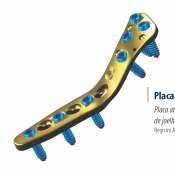 corretiva de joelho Tíbia proximal medial Placa PBA-S de Osteotomia Proximal Lateral de Tíbia
