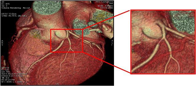 Figura 1 - Angio TC de um paciente de 66 anos, masculino, assintomático. Em destaque se observa presença de lesão obstrutiva na artéria descendente anterior.