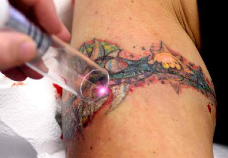 É importante destacar também a dor que o tratamento a laser para remoção de tatuagem causa.