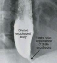 OUTROS EXAMES: Radiografia simples do tórax ausência de ar no estômago hipotransparência mediastinal ao lado da aorta nível hidroaéreo mediastinal Esofagografia baritada dilatação