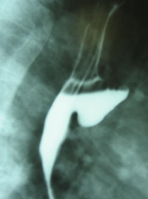 DIAGNÓSTICO: Esofagografia baritada Endoscopia: risco de perfuração