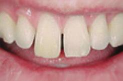 do sorriso com Diastema 1.