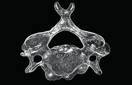 anatômica das estruturas - Presença de osteófitos; - Movimentos realizados; - Região de