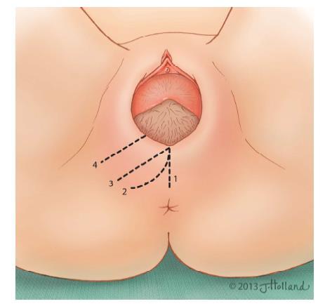 Episiotomia Secção de 4-5 cm de comprimento de região vulvar Compreende pele, mucosa vaginal, TSC, músculo bulbocavernoso e transverso do