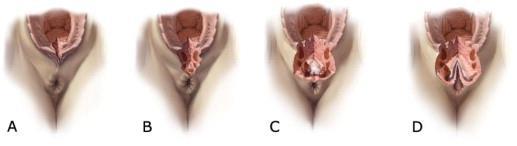 Obstetrics and Anal Sphyncter InjurieS (OASIS) Primeiro grau: epitélio vaginal ou pele perineal Segundo grau: musculos perineais (bulbocavernoso, transverso perineal) Terceiro