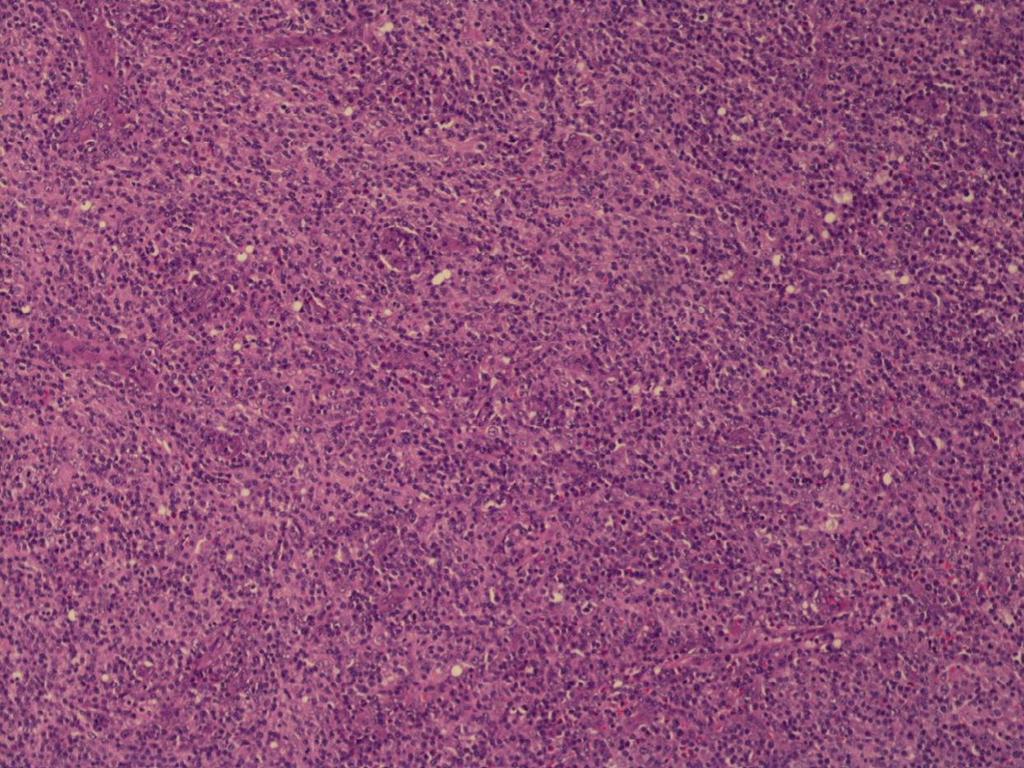 5 Estes marcadores, que são característicos de células TFH, podem ser utilizados na prática diagnóstica, quer por citometria de fluxo, quer por imuno-histoquímica e, auxiliam na identificação da