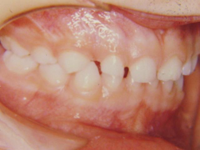 20 Na dentição Decídua os dentes são guiados ás suas posições oclusais pela matriz funcional dos músculos durante cada crescimento ativo do esqueleto facial; quando os dentes irrompem e os músculos
