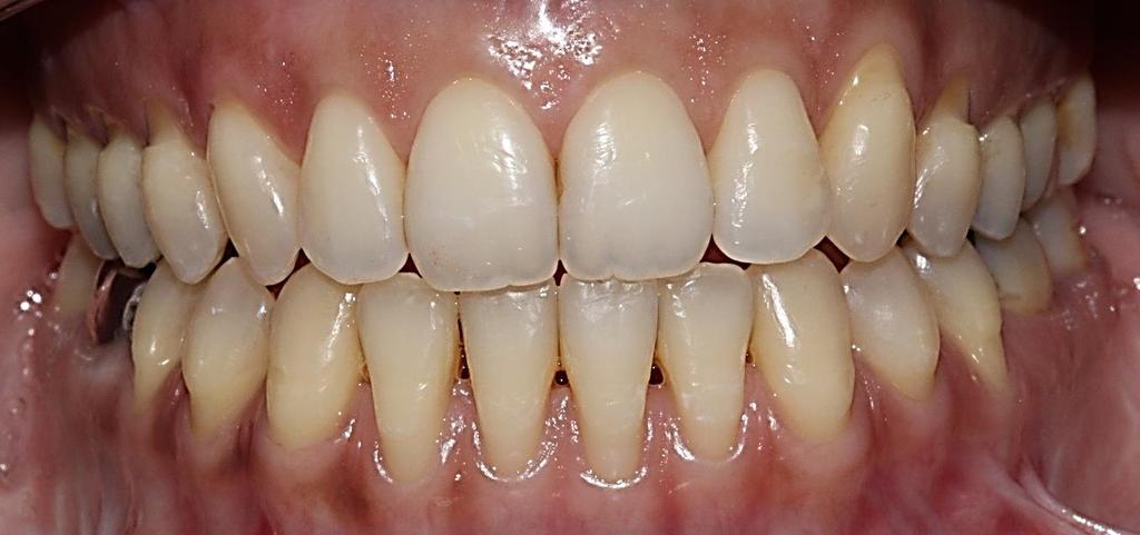 Saúde periodontal original: ausência total de inflamação e sem perda de inserção ou óssea. Saúde periodontal clínica: ausência ou níveis mínimos de inflamação clínica em periodonto com suporte normal.