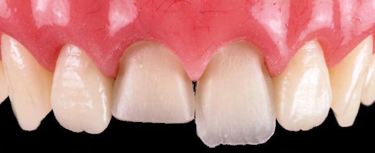 Estabelecer um protocolo de acabamento e polimento, otimizando a forma e a textura dental, além de