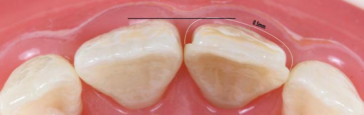 Durante a estratificação, é importante tentar planejar o volume preciso de dentina, deixando o espaço