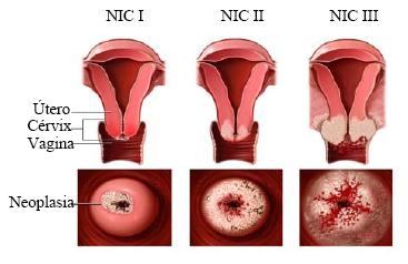 Papilomul cervical este tratat Cauze papilom
