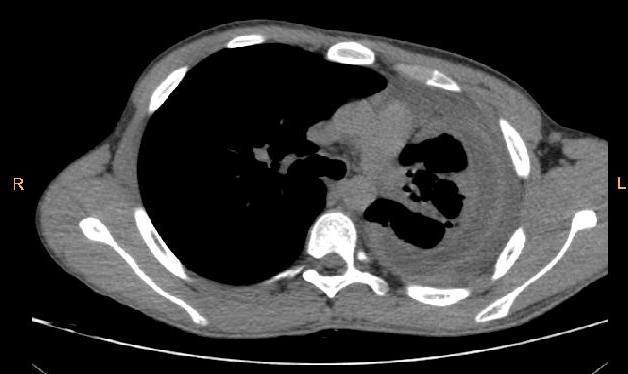 Figura 2 tomografia do tórax póstoracocentese de alívio, com derrame e