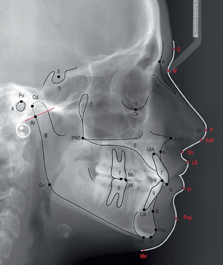 Introdução Figura 1 - Exemplo de traçado cefalométrico e pontos anatómicos (Adaptado de Handbook of Orthodontics, 2015). A partir dos valores aferidos é realizada a análise cefalométrica.