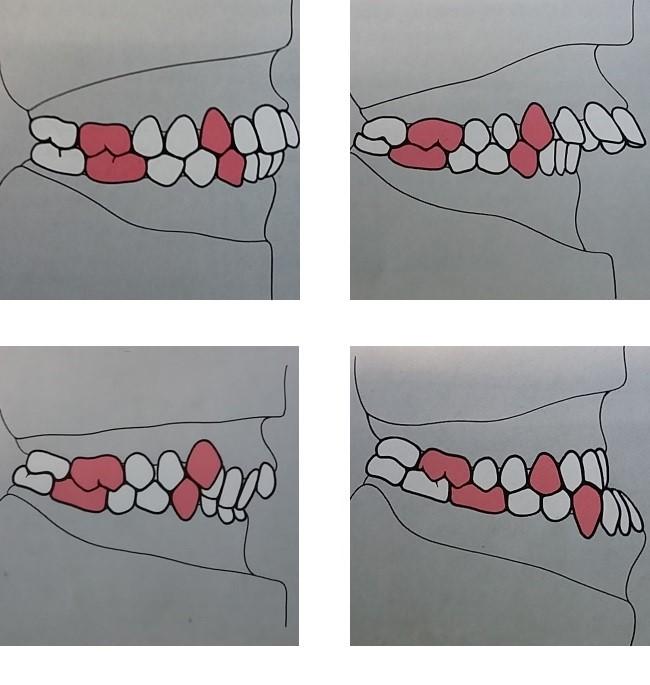 Introdução Má oclusão de classe II: Existe uma relação distal da mandíbula com a maxila onde o sulco vestibular do primeiro molar inferior oclui posteriormente à cúspide mesiovestibular do primeiro