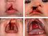 Hearing process in children with cleft lip and palate with or without history of otitis
