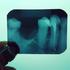 Avaliação clínica do sistema ProTaper na instrumentação de canais de dentes posteriores