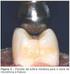 Resistência à fratura de dentes com perda estrutural restaurados com resina composta e sistema adesivo autocondicionante