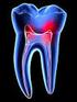 ESTUDO DO SISTEMA DE CANAIS RADICULARES EM DENTES COM HIPERCEMENTOSE