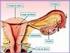 O rastreamento do câncer de colo uterino