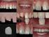 ! 1. Alterar forma e/ou cor vestibular dos dentes; 2. Realinhar dentes inclinados para lingual. Restaurações estéticas anteriores diretas.