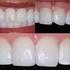 Imitando a natureza em restaurações diretas com resina composta em dentes anteriores.